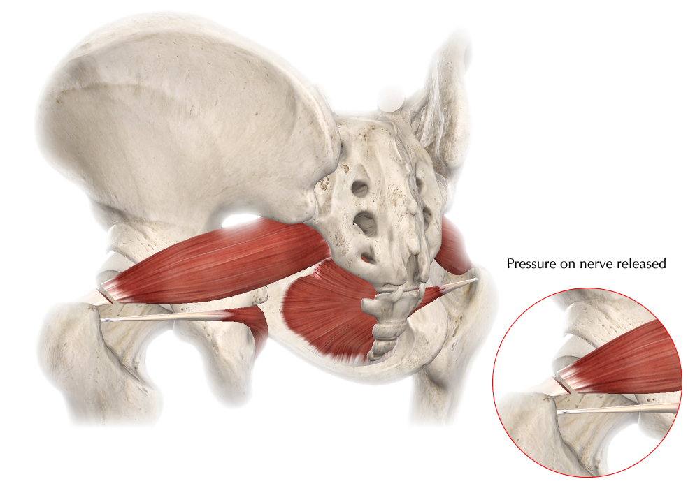 Piriformis Syndrome Faqs Hip And Pelvis Doctor Articles Asia Medical Specialists